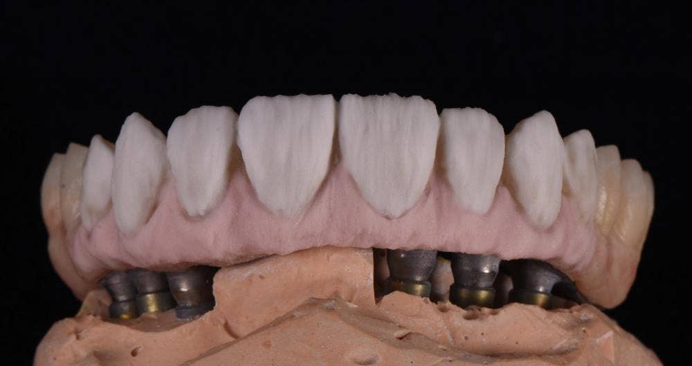 Keeping it smart and simple: Micro-layering of implant supported reconstructions