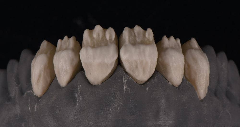 Mikrovrstvení s CERABIEN™ MiLai