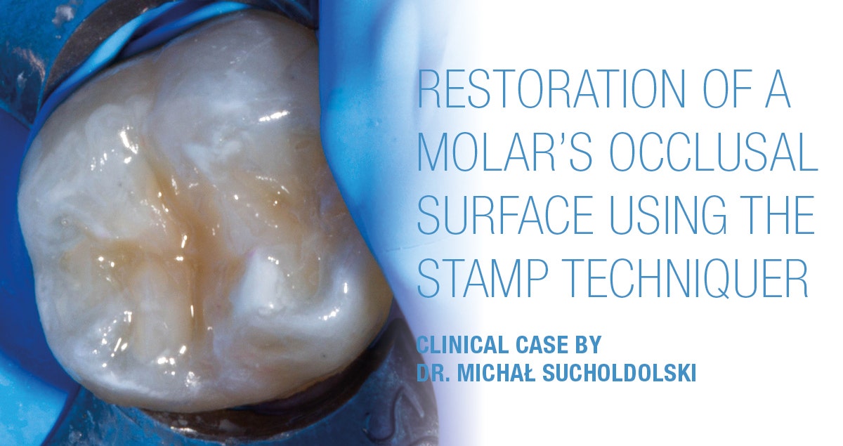 Restoration of a molar’s occlusal surface using the stamp techniquer with CLEARFIL MAJESTY™ ES Flow