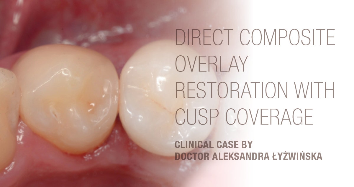 Clinical case - Direct composite overlay restoration with cusp coverage