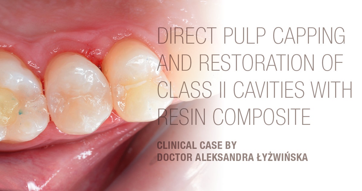 Direct pulp capping and restoration of class II cavities with resin composite