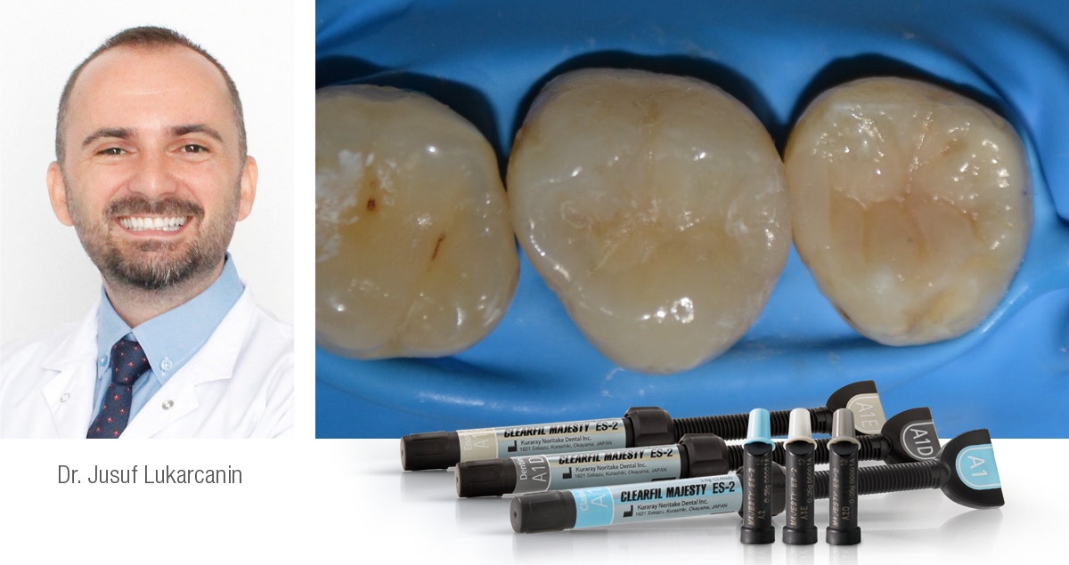 Posterior restoration procedure for predictable outcomes