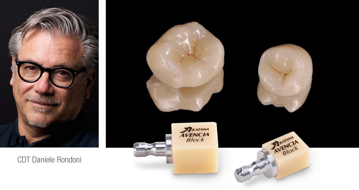 Replacement of Class II restorations with hybrid-ceramic overlays