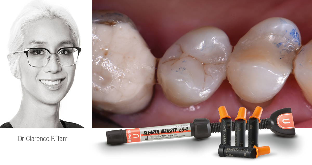 Cas clinique d'une prémolaire restaurée avec CLEARFIL MAJESTY™ ES-2 Universal
