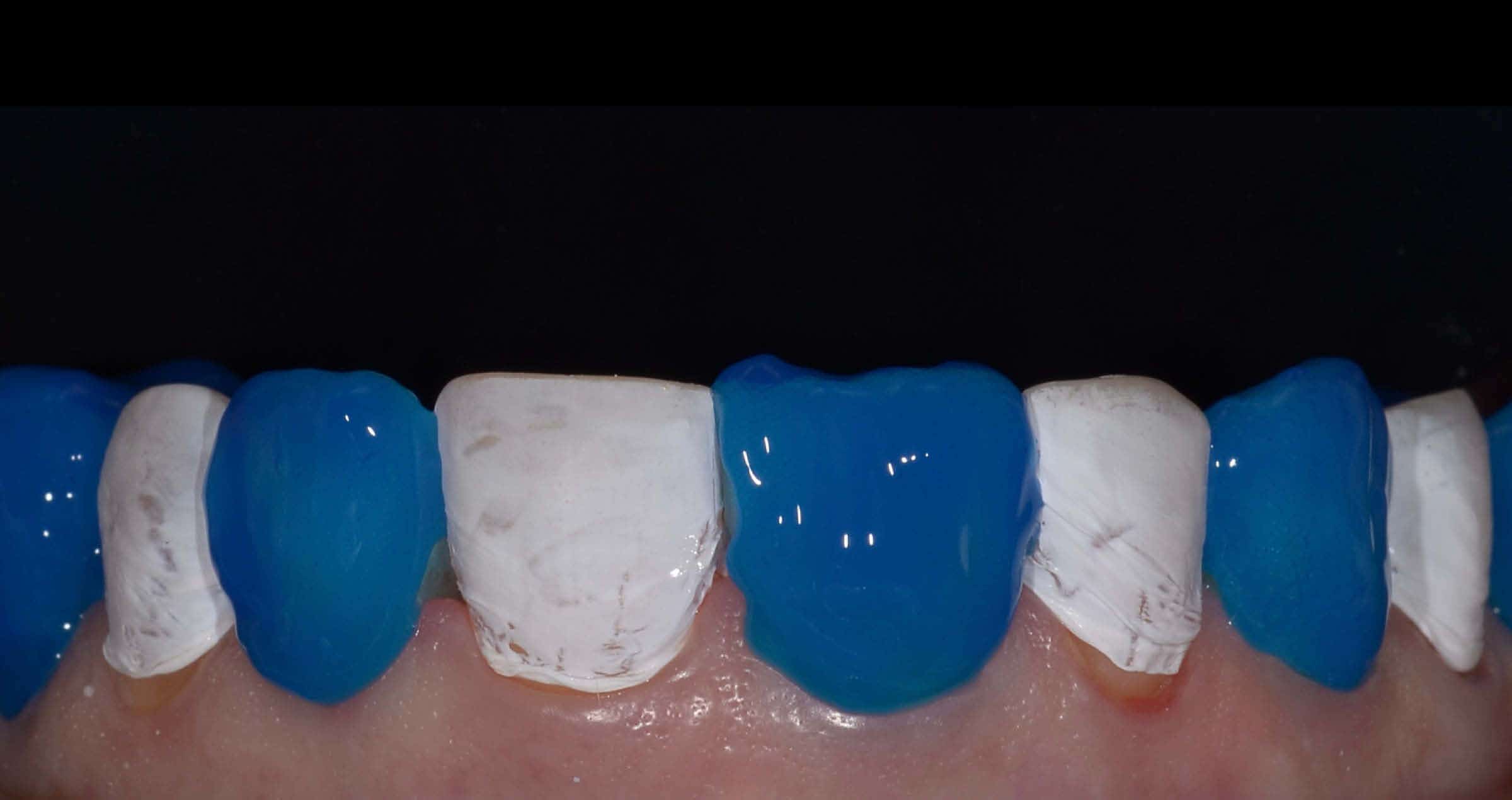 Flowable injection technique, a flowable composite revolution
