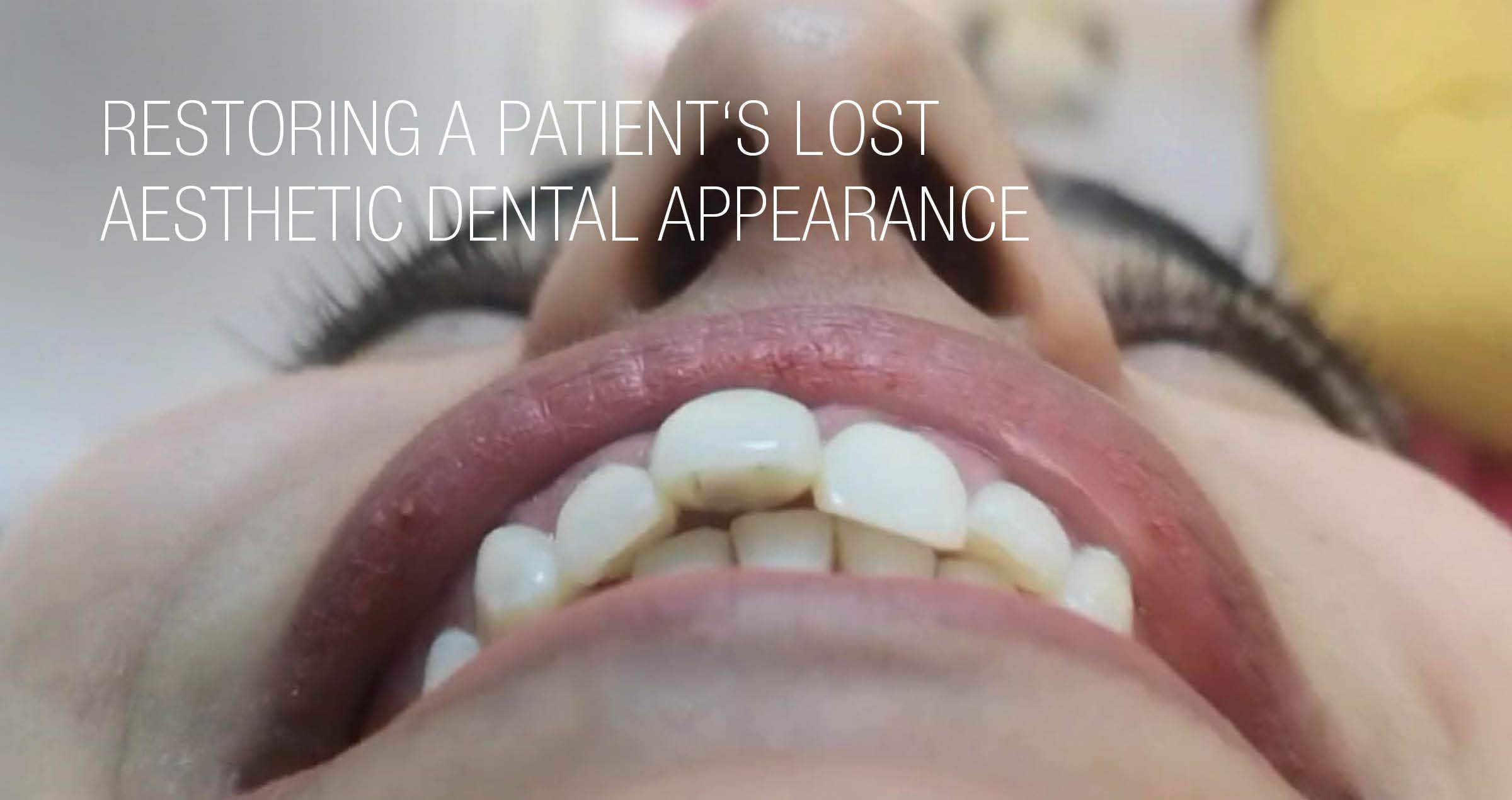 KATANA™ Zirconia UTML veneers and crown on zirconia implant cemented with PANAVIA™ Veneer LC