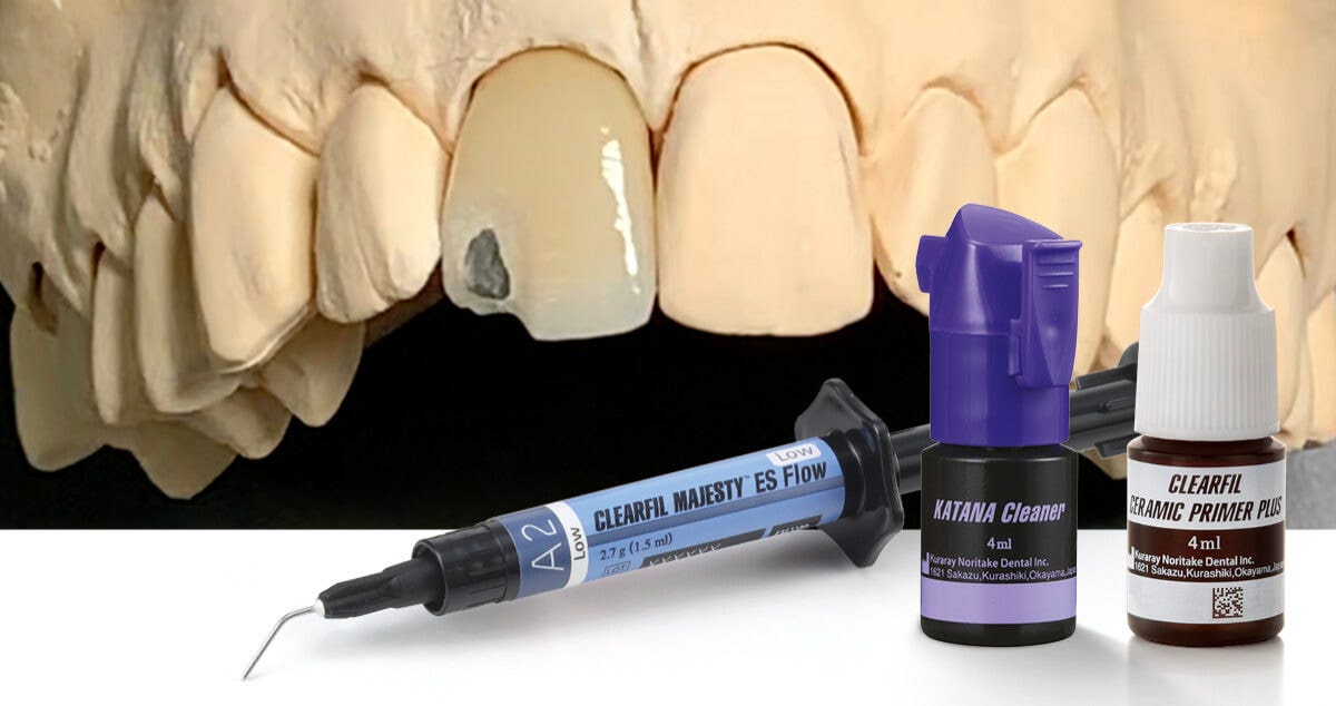 Chipping an einer keramischen Restauration: Intraorale Reparatur 