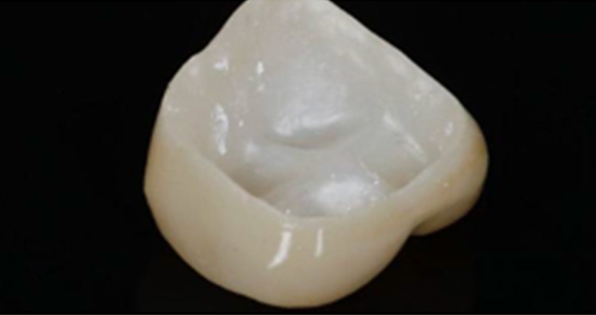 Adhäsive Befestigung von Kronen aus Lithium-Disilikat