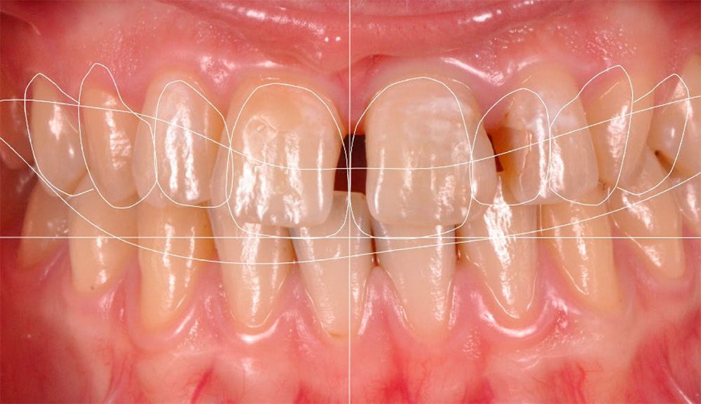 Der Weg zur Perfektion: Veneers aus Zirkonoxid (KATANA™ Zirconia YML) 