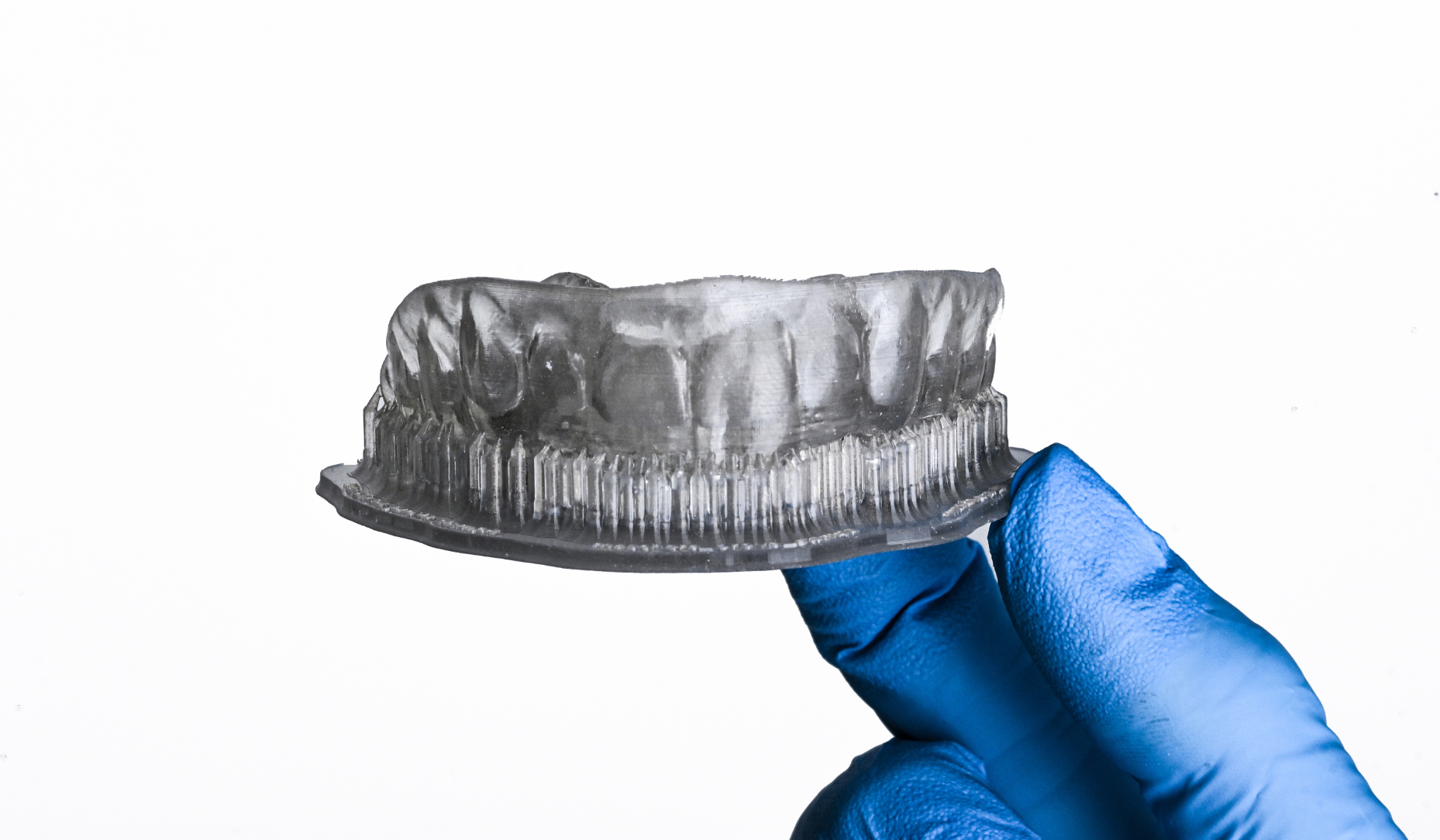 Dentisterie minimalement invasive et flux de travail numérique : application clinique de la technique d'injection de composite fluide