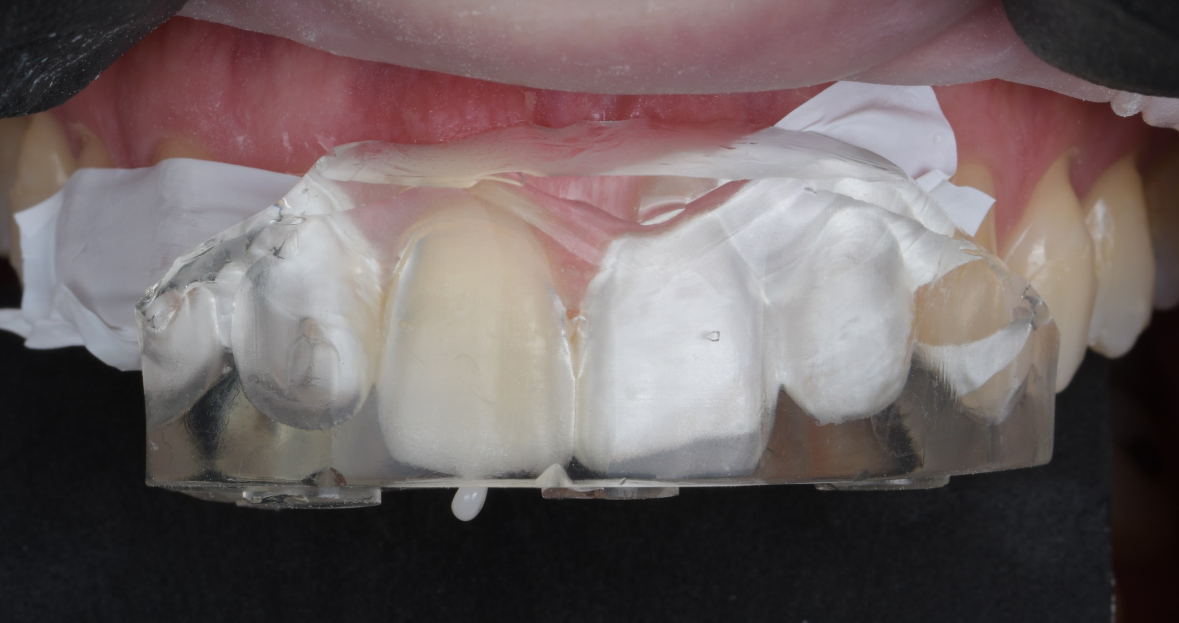 Use of the new CLEARFIL MAJESTY ES Flow Universal