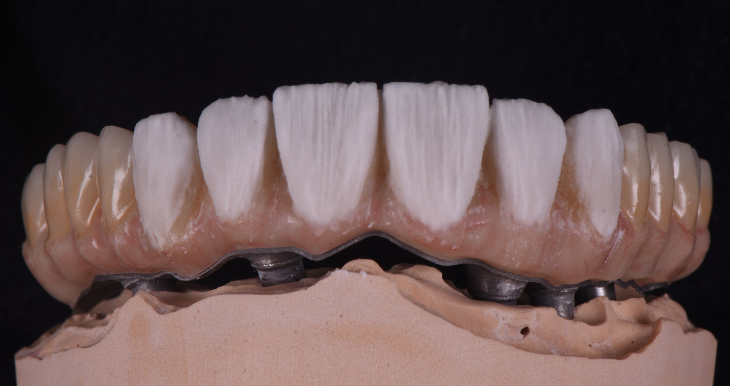 Micro-layering meets fixed implant-based prosthetics