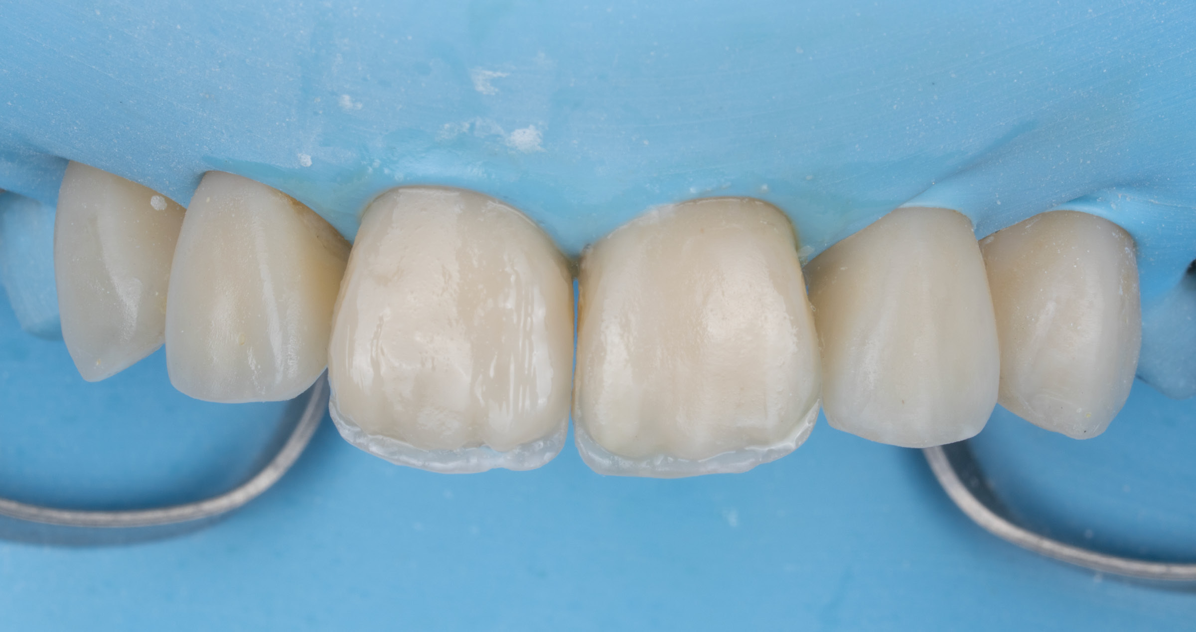 Composite veneering: adjustments easily accomplished