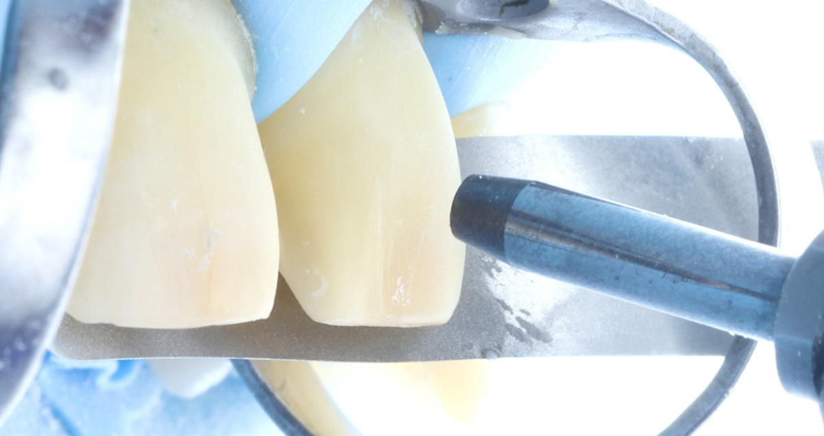 Full adhesive workflow with PANAVIA Veneer LC