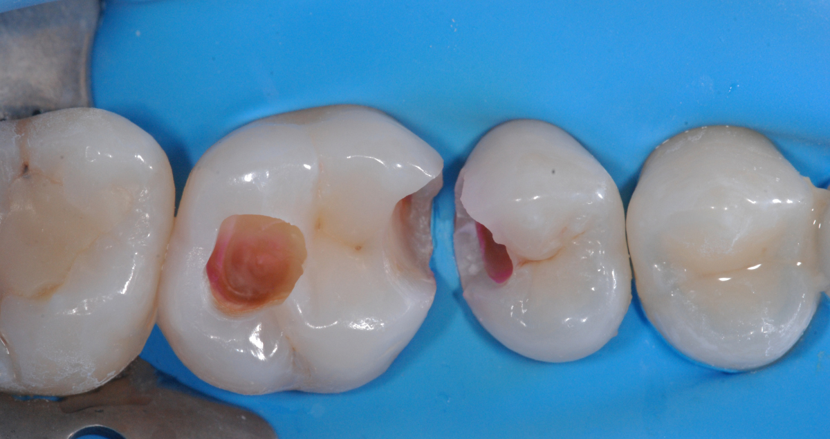 Materials techniques and technologies for conservative reconstruction in the posterior region