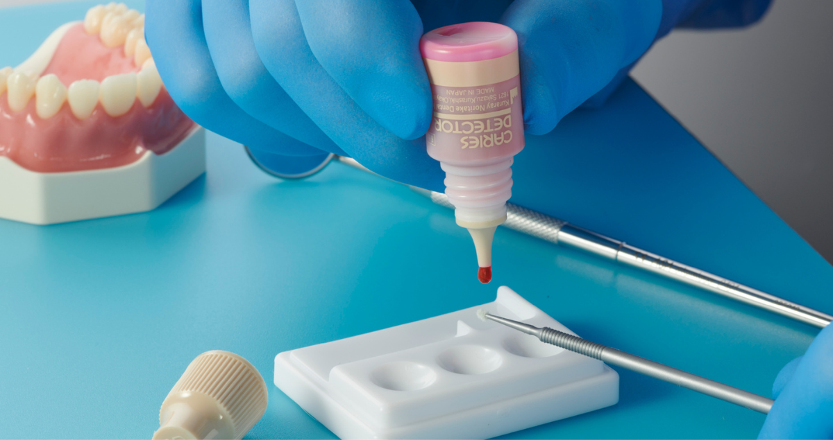 Caries Detector: creșterea preciziei în îndepărtarea conservatoare a cariilor