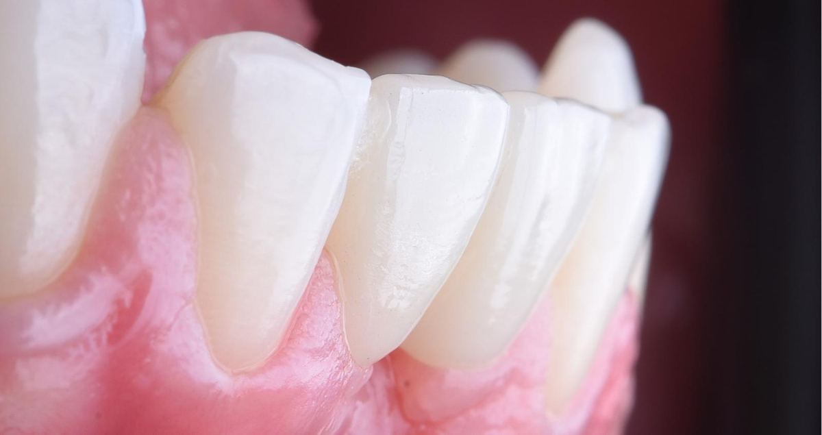 Îmbunătățirea formei și nuanței: înlocuirea unei punți adezive din motive estetice