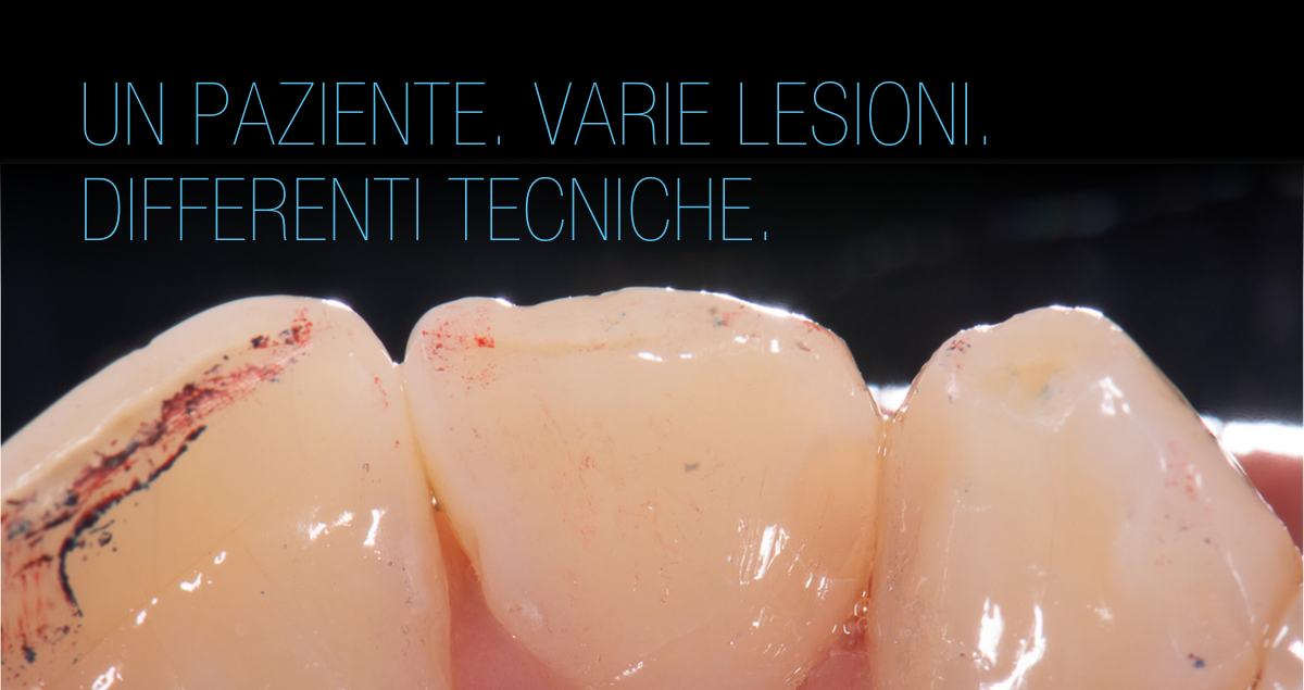Tecniche diverse per l’esecuzione di restauri diretti sullo stesso paziente