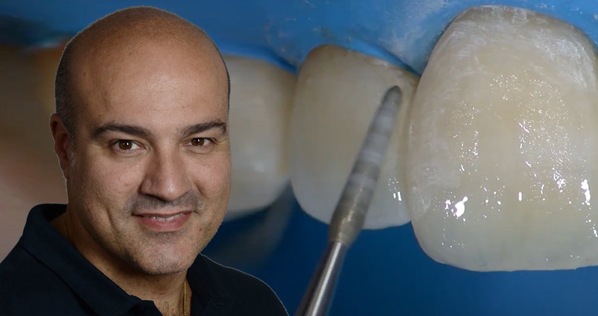 Recontouring with CLEARFIL MAJESTY ES-2