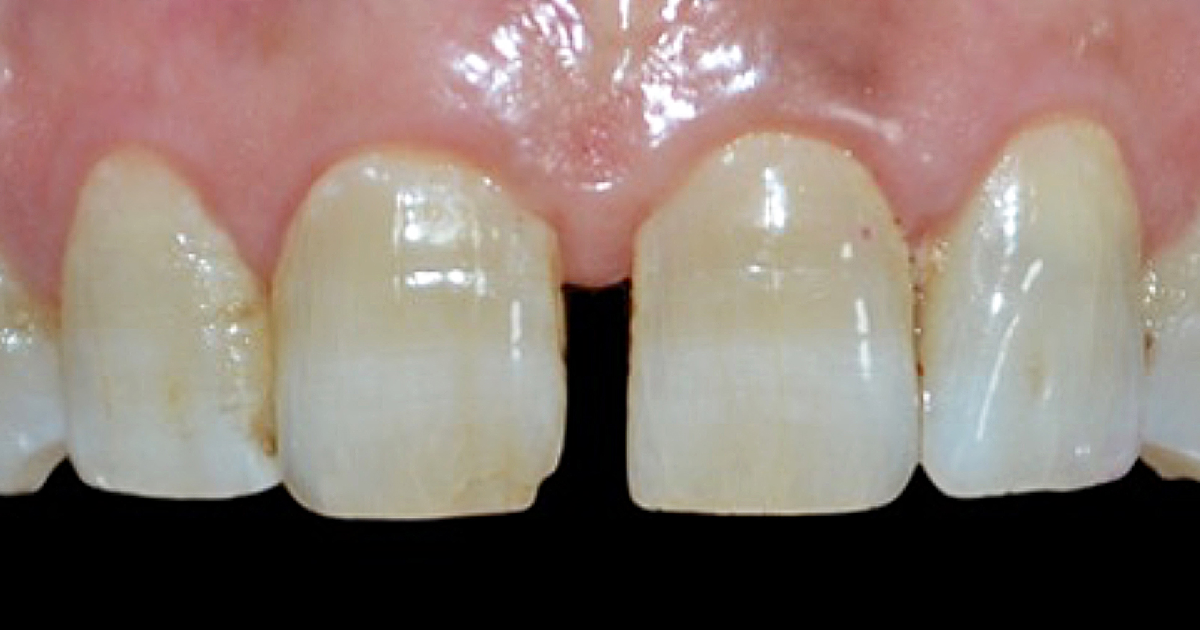 Clinical case with direct composite applications in anterior teeth