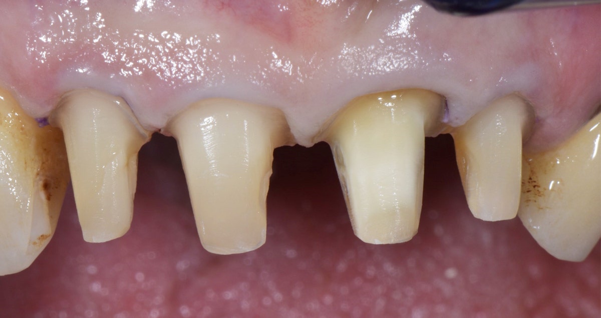 Clinical case - Crowns on 12/11/21/22