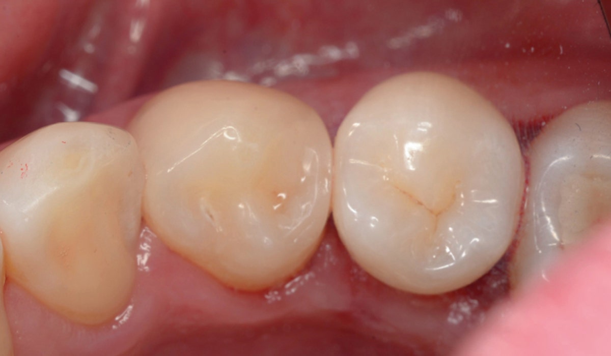 Restoration of a class II occluso-distal cavity with composite