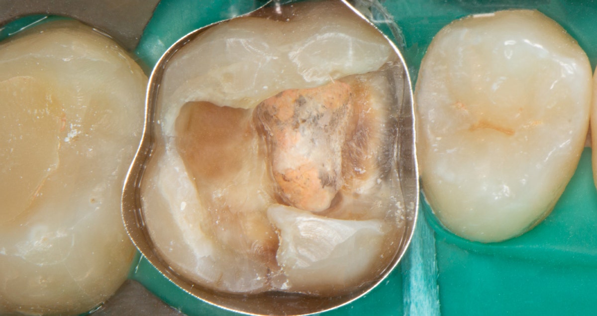Clinical case - Cavity Design Optimisation & Cervical margin Relocation