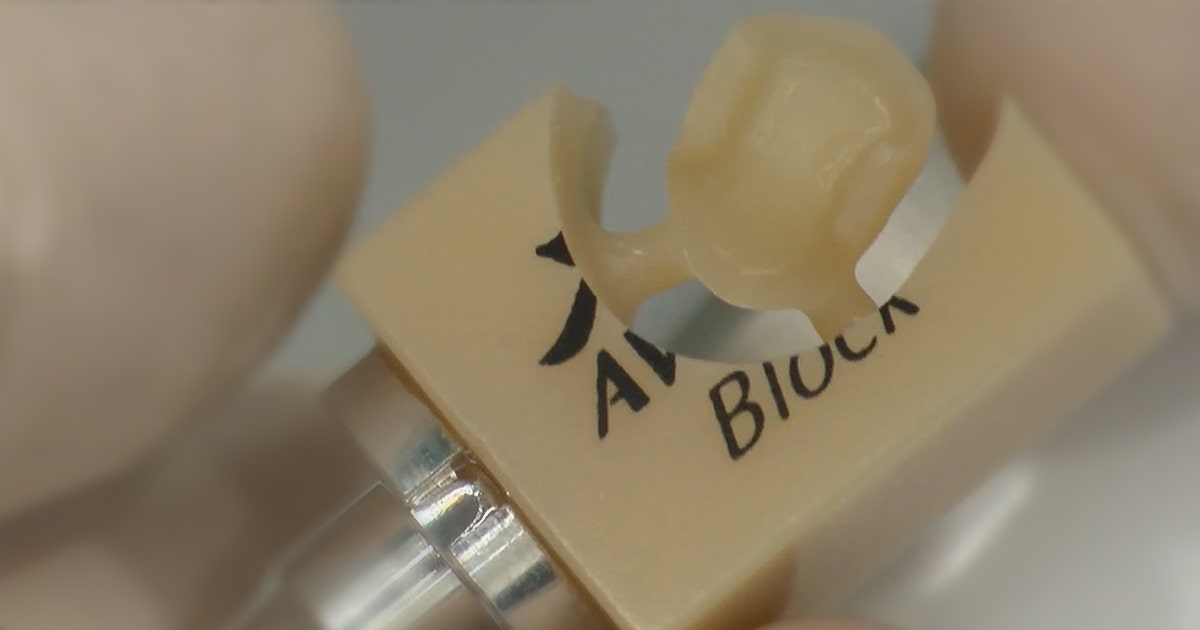 Clinical Case of KATANA AVENCIA Block and PANAVIA SA Cement Universal