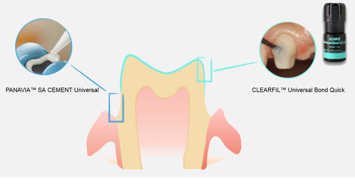 Selective Adhesive Luting (SAL): una nuova tecnica di cementazione adesiva