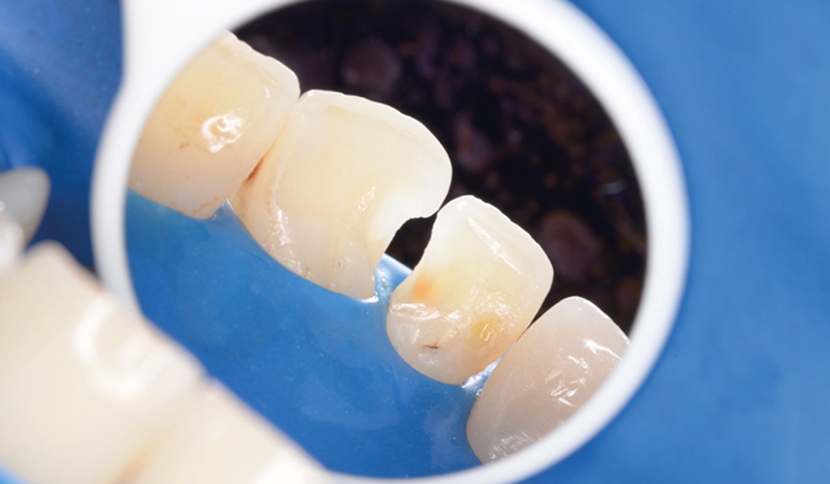 Replacement of two direct restorations in the anterior region