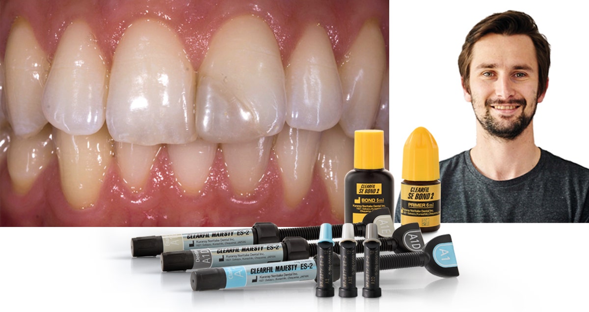 Highly aesthetic class IV composite restoration
