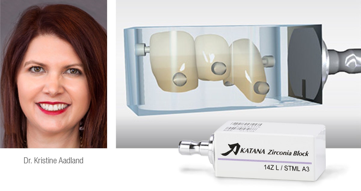 3-Unit anterior maxillary bridge