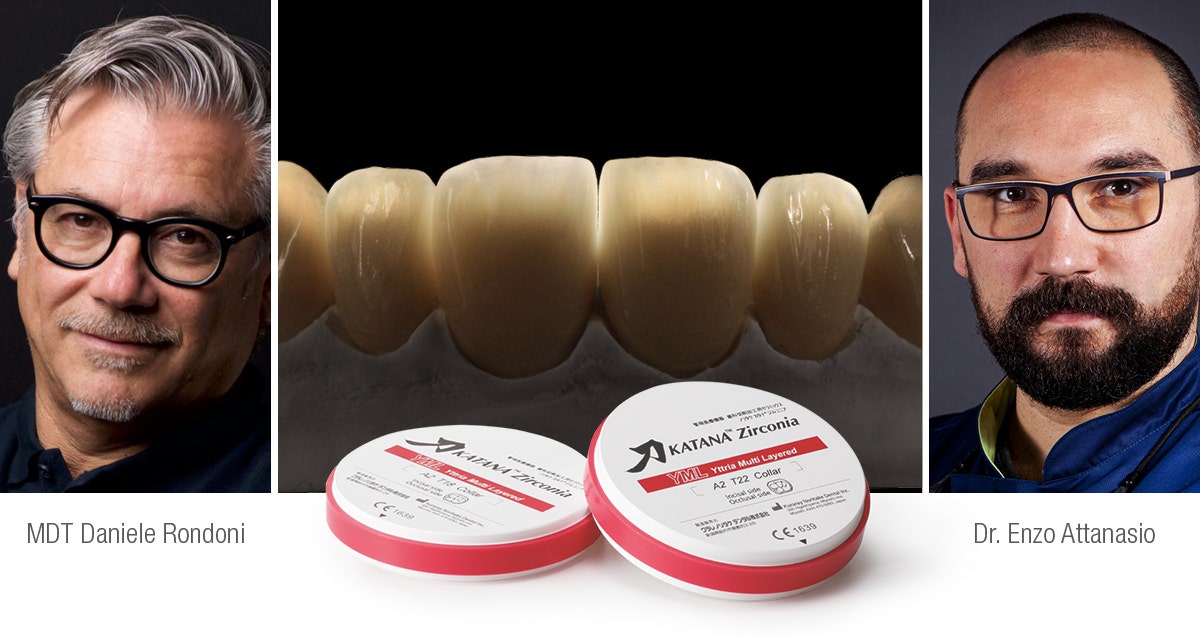 Behandeling van een jonge patient met zirconia veneers