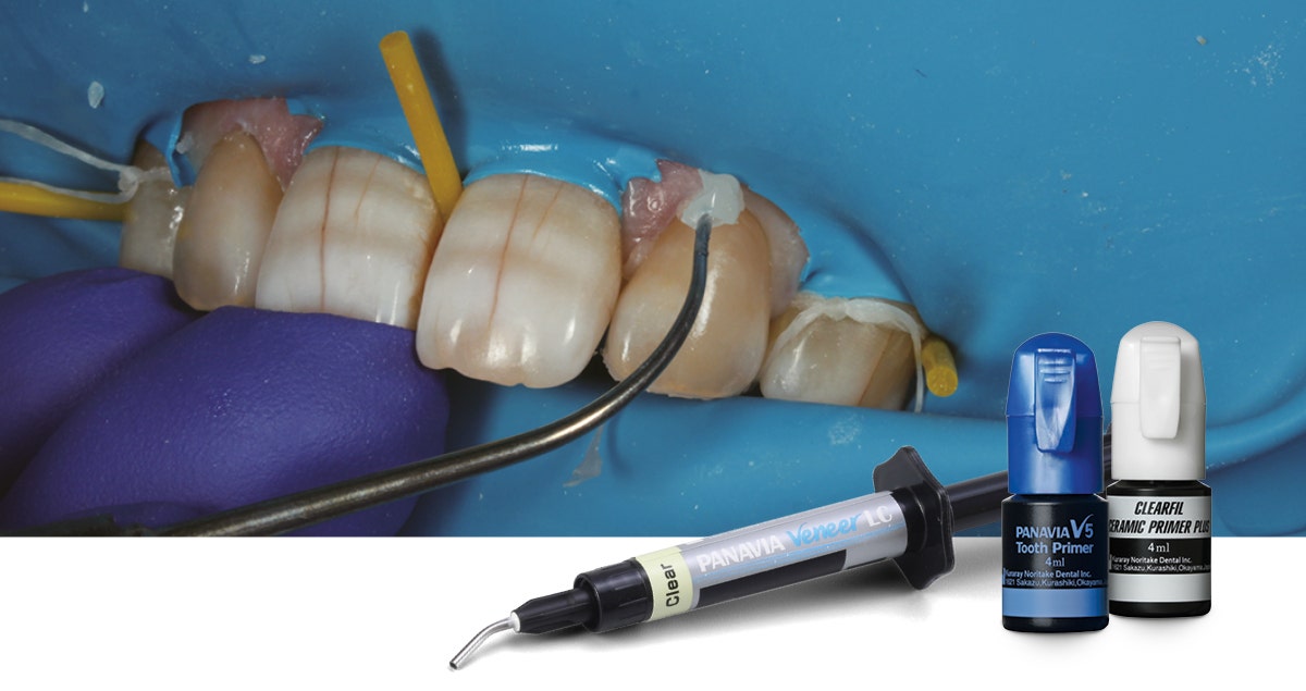 Laminate veneer restoration using lithium disilicate glass prosthetic restorations