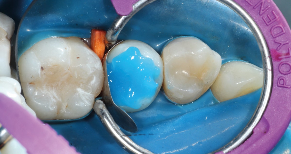 Class II cavities restored with composite raising the margin and re-establishing the contact point