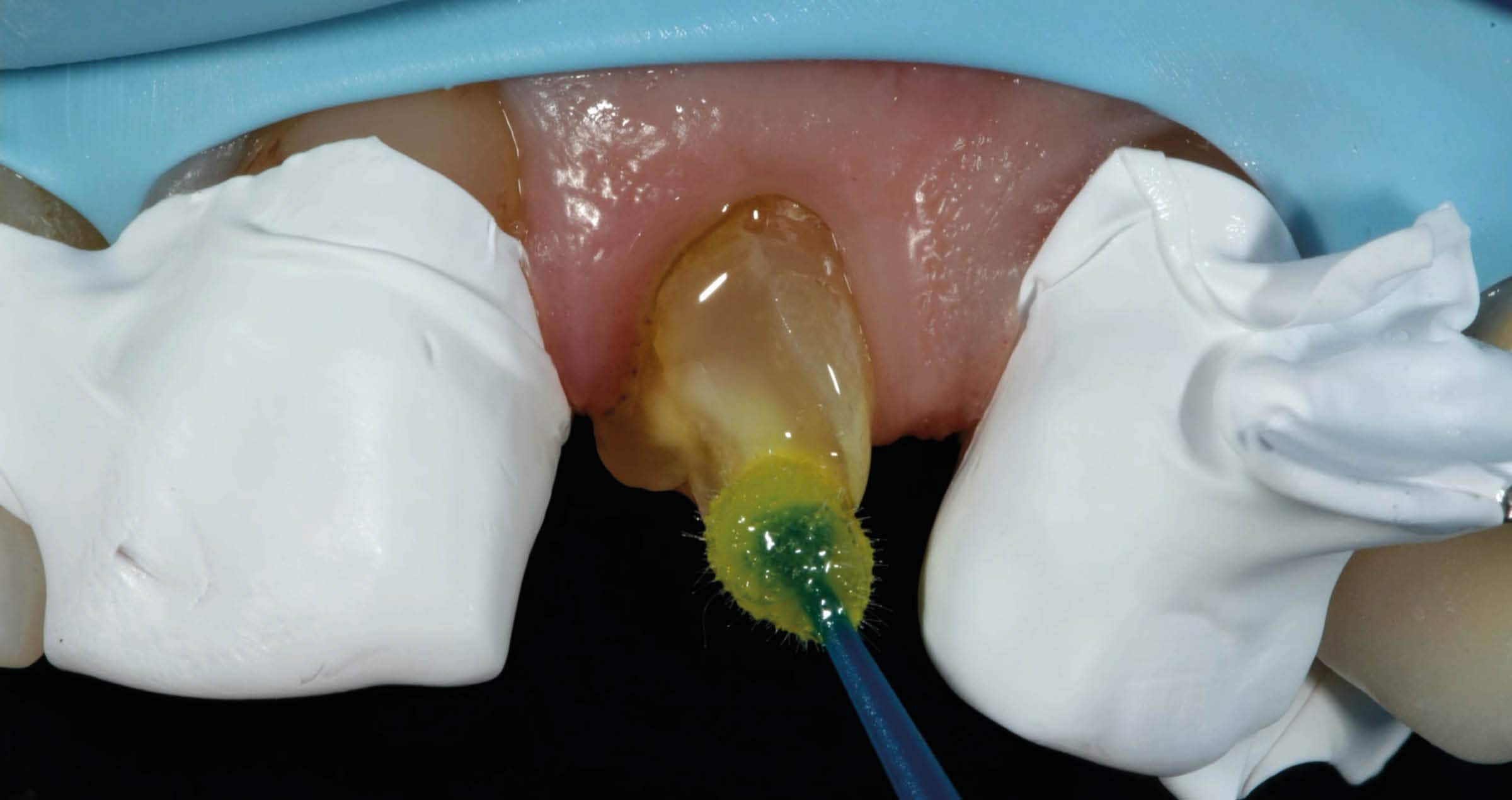 Universal adhesives: rationalizing clinical procedures