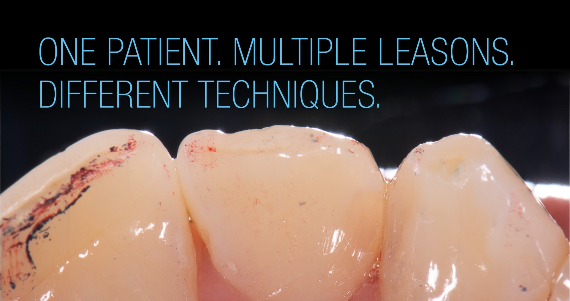 Different direct restoration techniques in one patient case