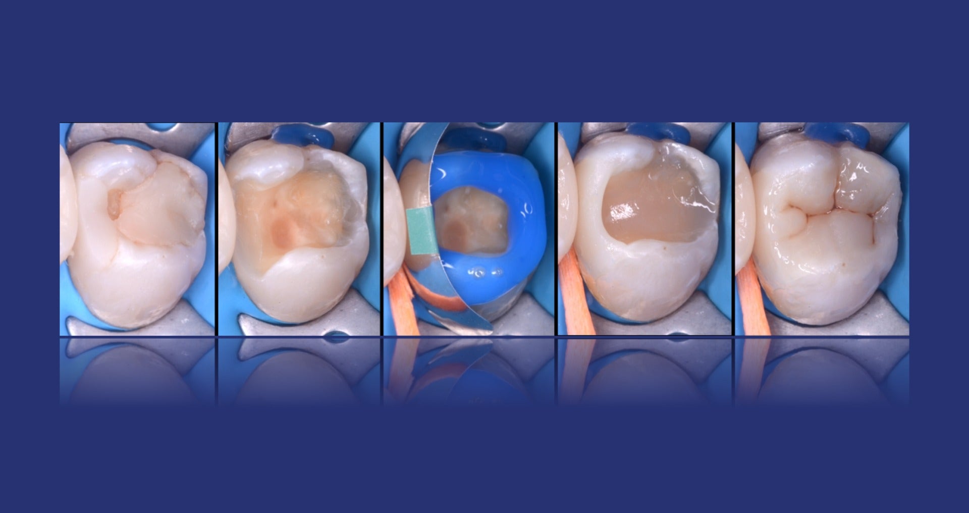 Ottenere il massimo dell'estetica nelle moderne riabilitazioni in zirconia