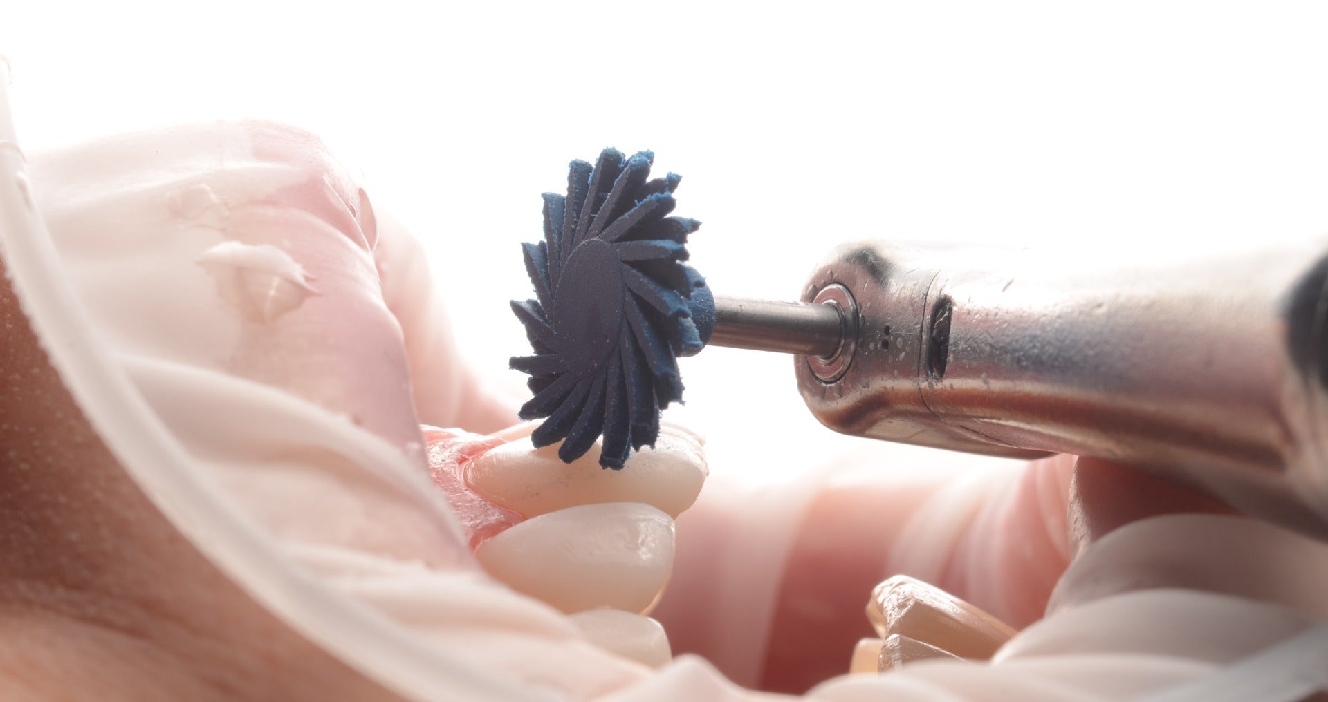 Composite fluide : comment polir les restaurations ? 