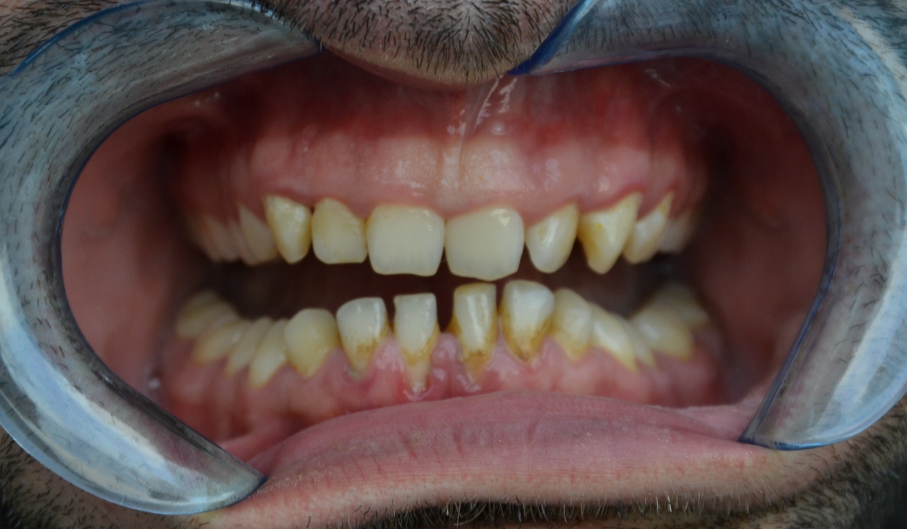 Universal Light : pour des résultats naturels et des dents plus lumineuses