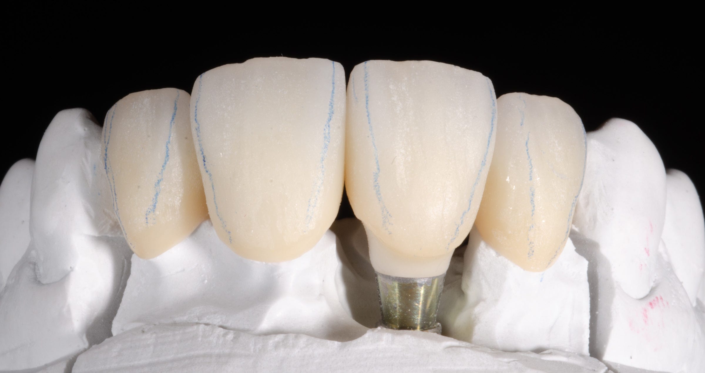 Anterior crowns on teeth and an implant