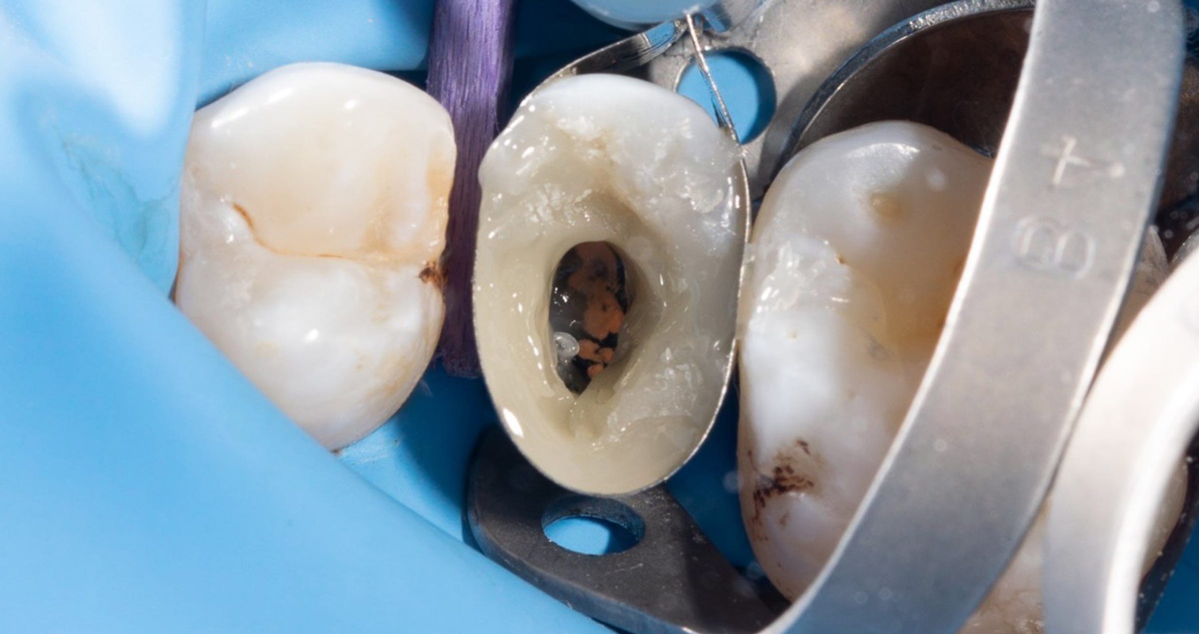 Large cavity restoration with resin composite: which materials to choose?
