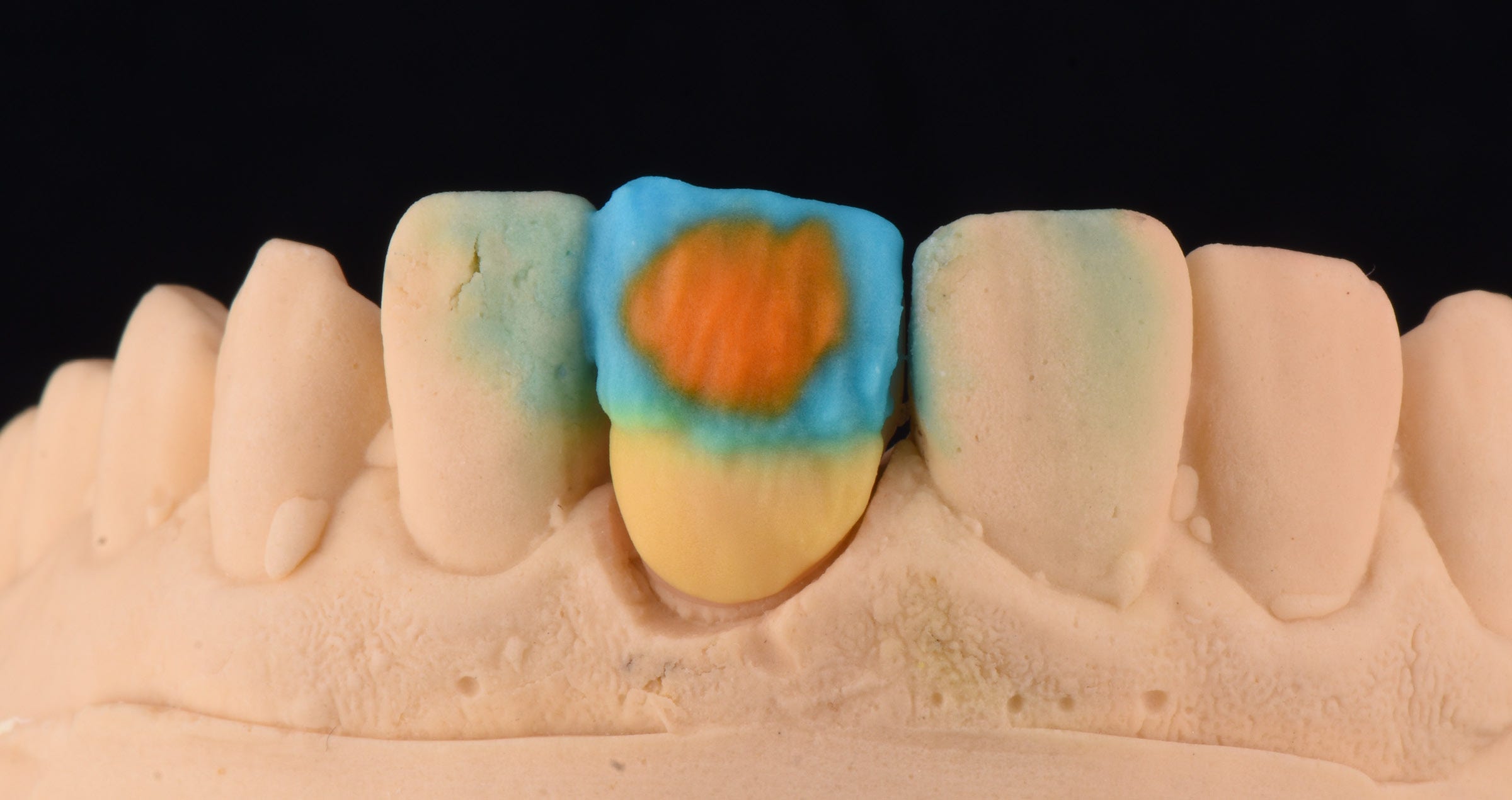Restoration of a single central incisor: Mastering the art of observation