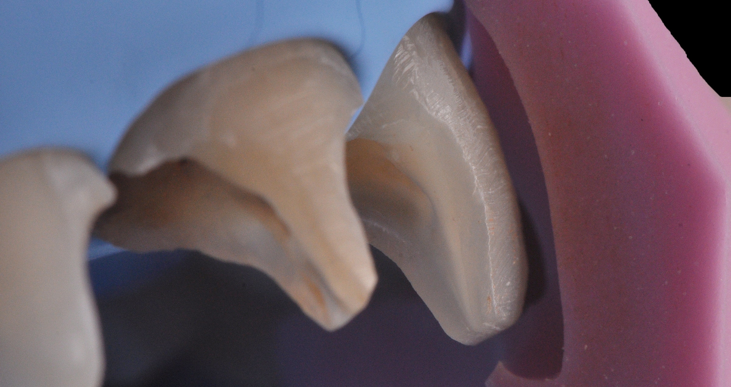 BEST.FIT: A hybrid technique for an efficient and aesthetic restoration of anterior teeth