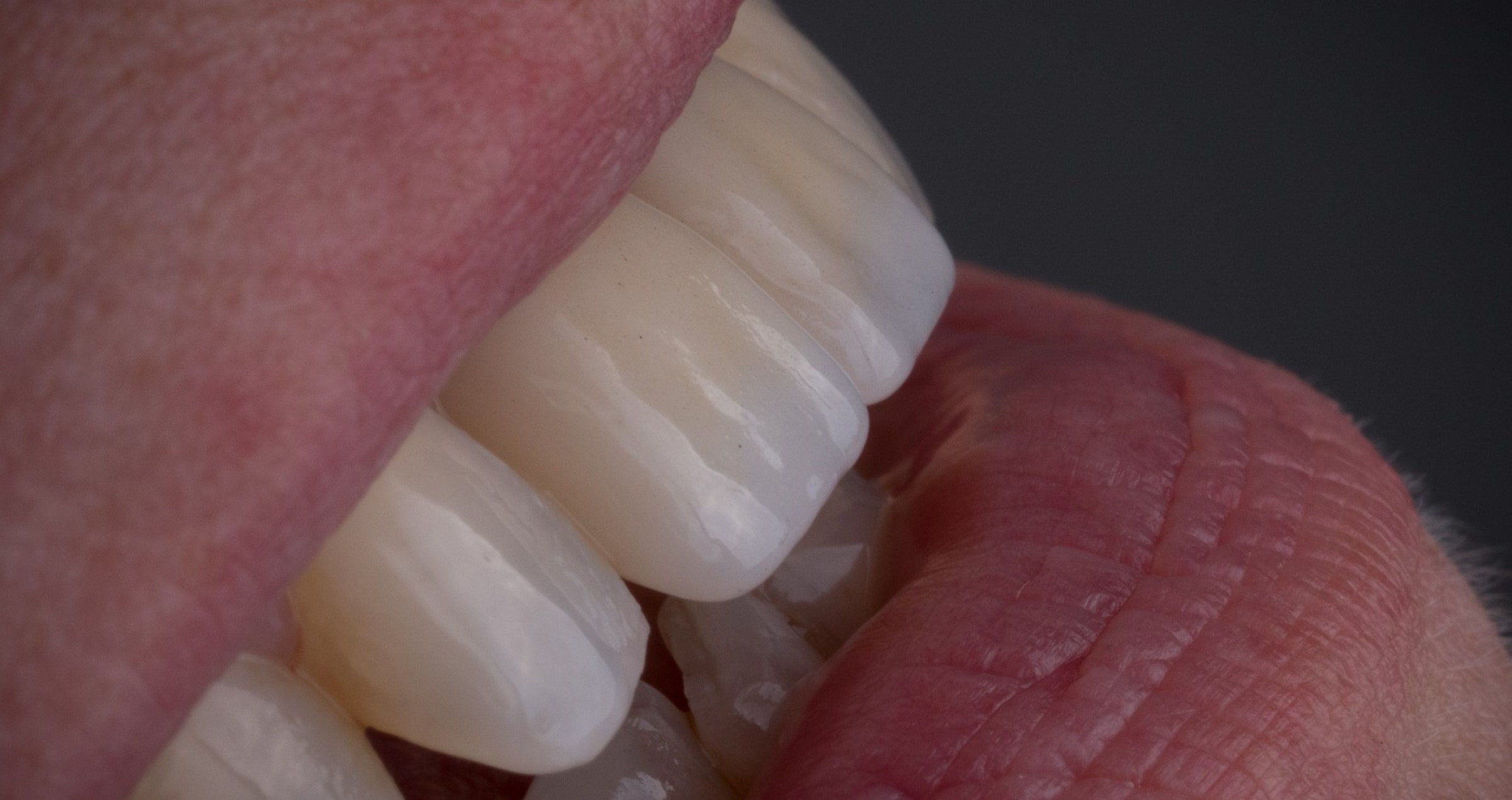 Same-day dentistry: Replacement of two PFM crowns with zirconia restorations