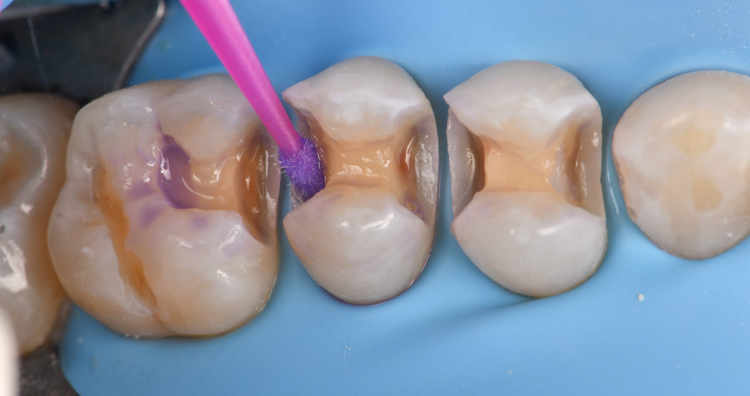 Optimizing intraoral and extraoral substrates for maximal adhesive potential