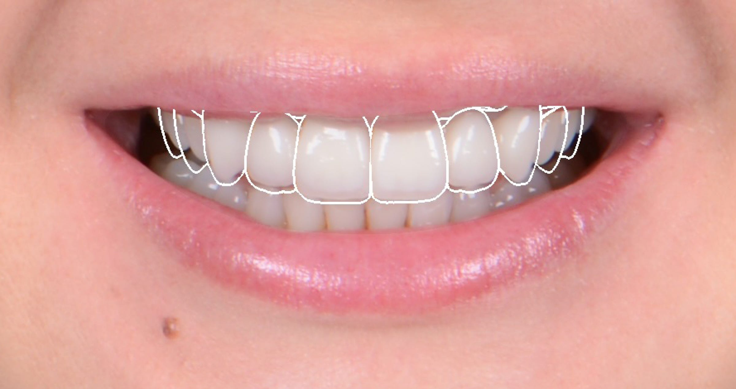 A new bright smile