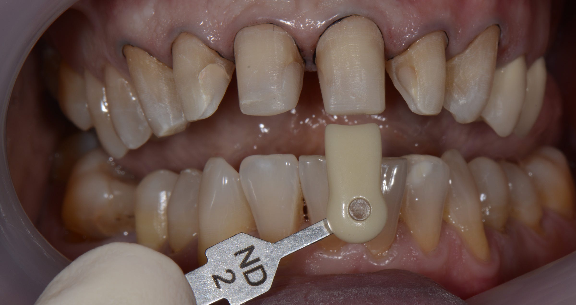 Micro-layering: are there benefits of using a dedicated porcelain system?
