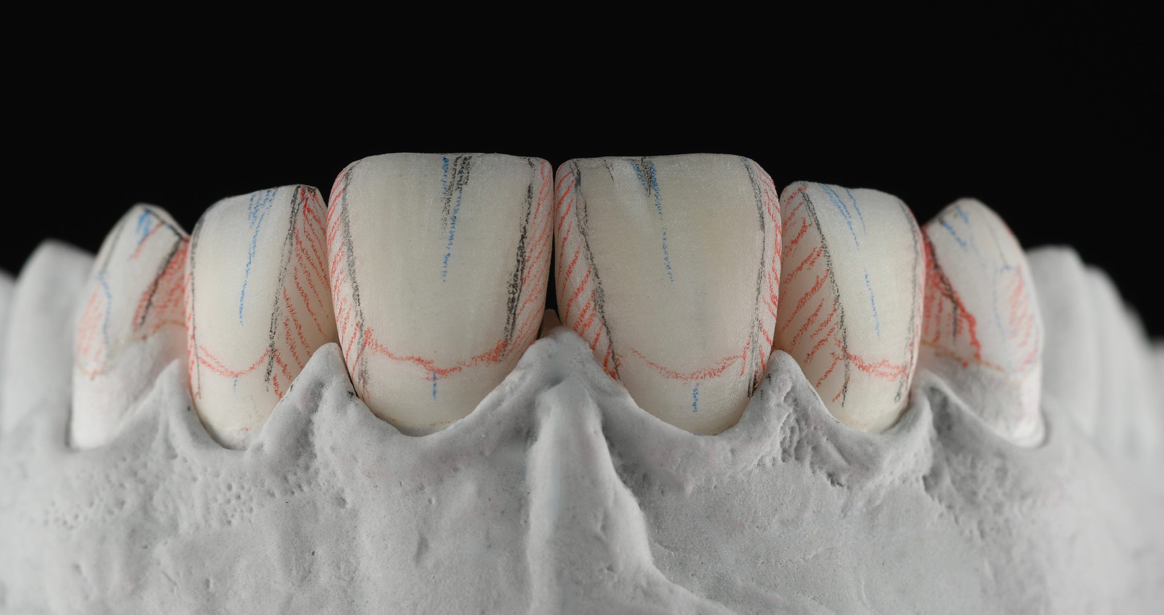 Kosmetyczne licówki feldszpatowe: estetyczne podejście do leczenia