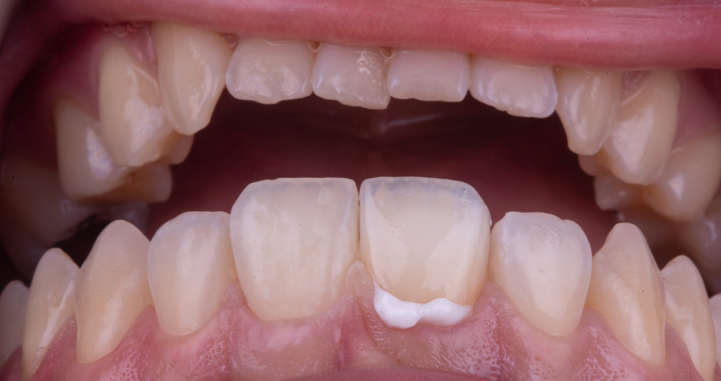 Restoring confidence after trauma: a biomimetic approach